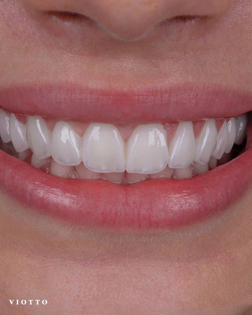 Sorriso com lentes de contato dental feitas na Clínica Viotto